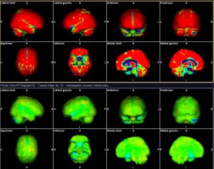 TEP FDG : cerveau : logiciel de comparaison avec une population normale : anomalie du cervelet à droite