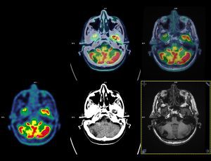TEP FDG : cerveau : fusion avec scanner et IRM : anomalie du cervelet à droite sur les 3 modalités d’imagerie