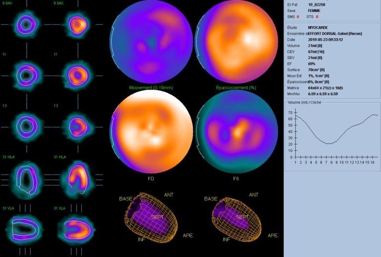 Scintigraphie myocardiaque : images dites paramétriques pour étudier la contraction du coeur : examen normal
