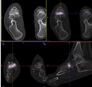 Scintigraphie osseuse : couplée au scanner, 3 plans : fracture de l’os naviculaire