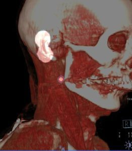 Scintigraphie du ganglion sentinelle: mélanome de l’oreille : reconstruction 3D, visualisation du site d’injection et du ganglion sentinelle