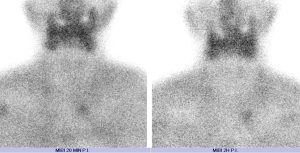 Scintigraphie des parathyroïdes : images statiques chez un patient opéré de la thyroïde, anomalie cervicale inférieure gauche