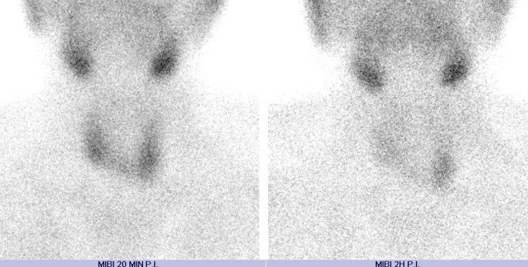 Scintigraphie des parathyroïdes : anomalie cervicale inférieure gauche