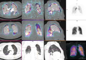 Scintigraphie pulmonaire : couplée au scanner : images de ventilation normales en haut, images de perfusion anormale au milieu en faveur d’une embolie pulmonaire du poumon gauche